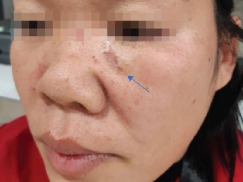 Nắng nóng có thể là yếu tố nguy cơ dẫn tới ung thư da