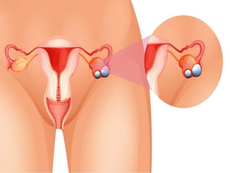 Phân loại giai đoạn của ung thư buồng trứng giai đoạn 1