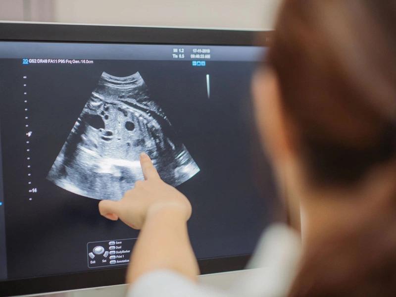 Phương pháp chẩn đoán ung thư buồng trứng giai đoạn 1