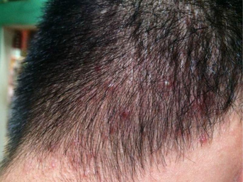 Phương pháp điều trị ung thư da đầu