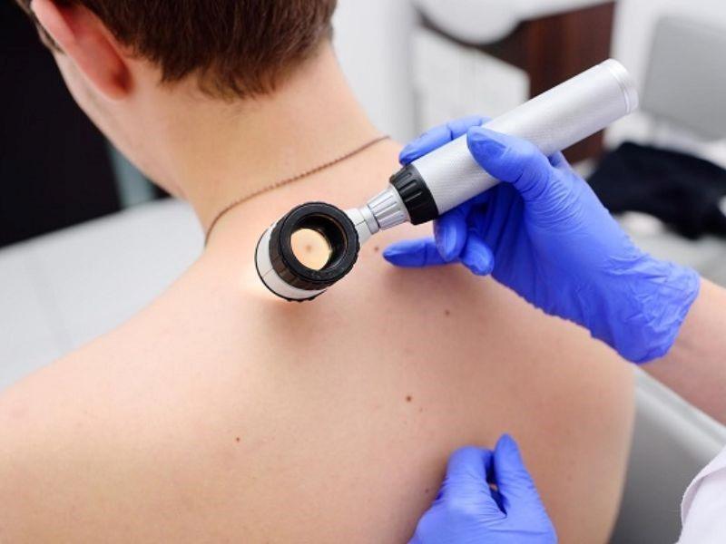 Phương pháp điều trị ung thư da giai đoạn cuối