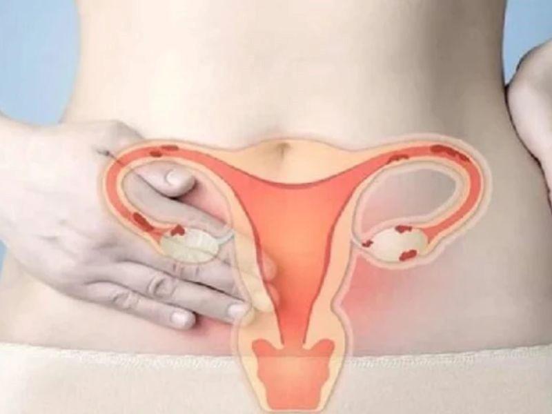 Tiên lượng sống của bệnh nhân ung thư buồng trứng giai đoạn 3