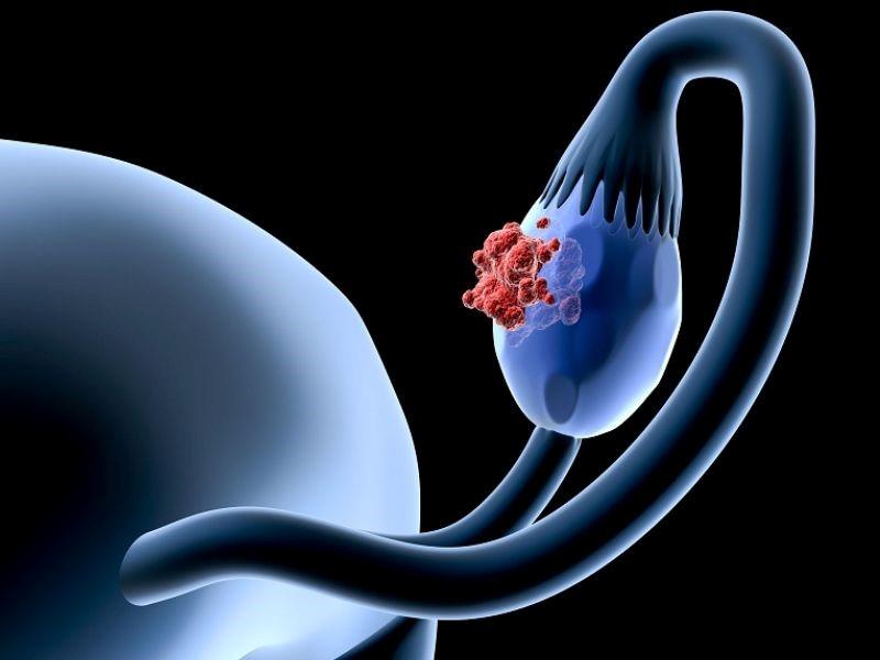 Tiên lượng sống của bệnh nhân ung thư buồng trứng giai đoạn 4