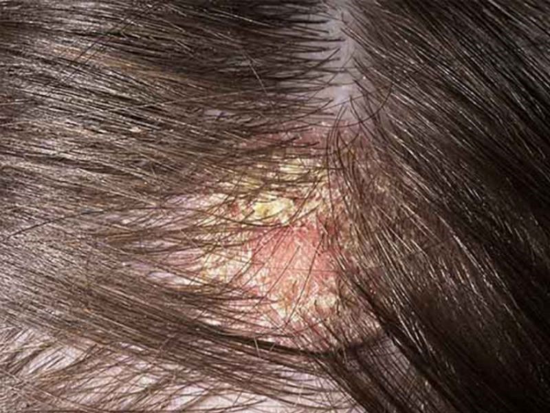 Triệu chứng của ung thư da đầu