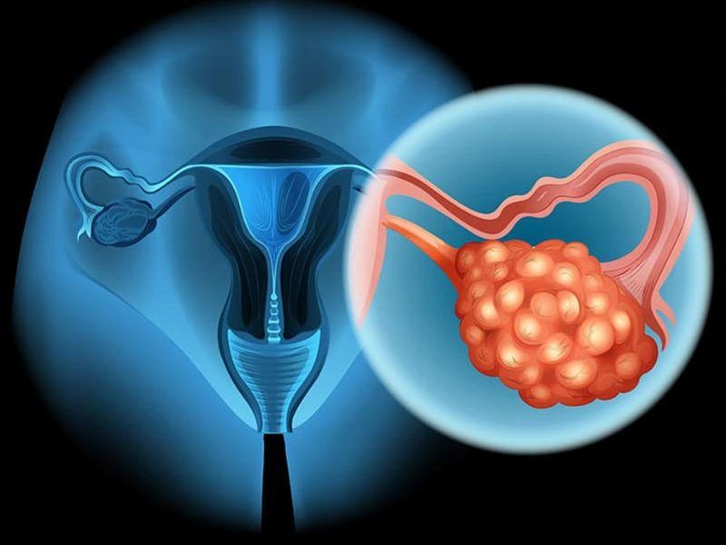 Ung thư buồng trứng có thể chữa khỏi nếu được phát hiện sớm và điều trị hiệu quả ở giai đoạn đầu.