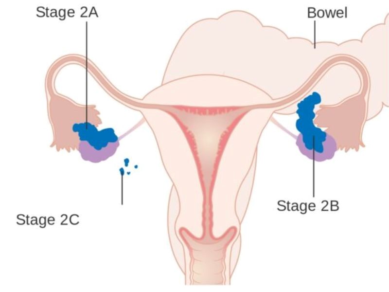 Ung thư buồng trứng giai đoạn 2