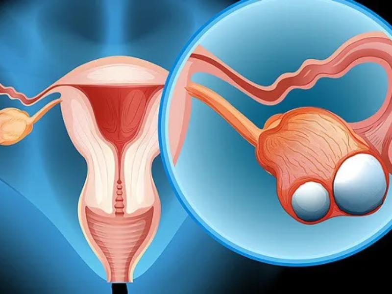 Ung thư buồng trứng giai đoạn 3
