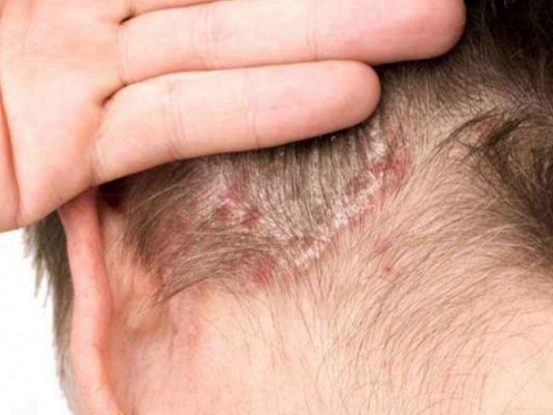 Ung thư da đầu ảnh hưởng nguy hiểm tới tính mạng