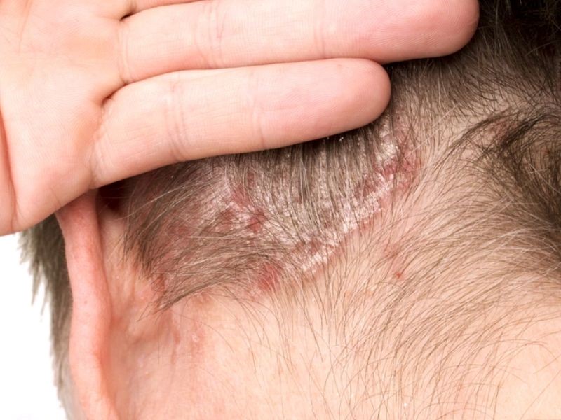 Ung thư da đầu vì nhuộm tóc