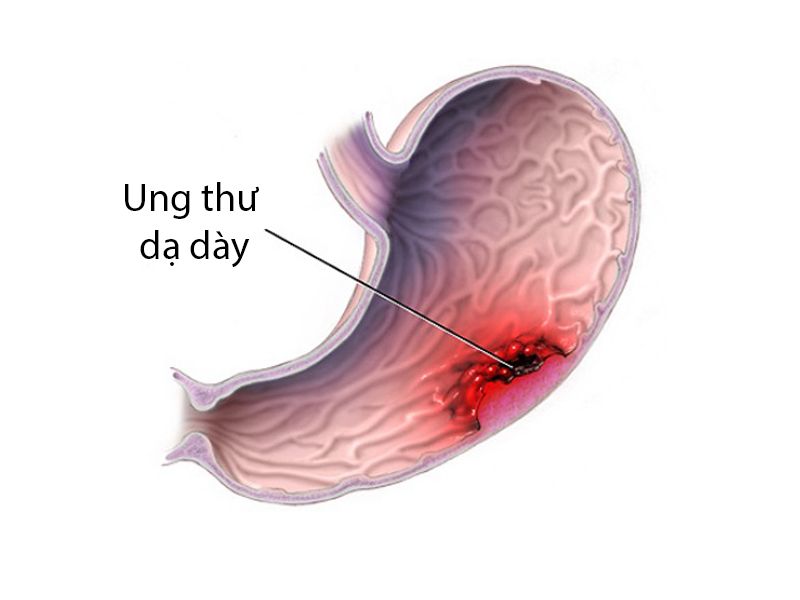 Các giai đoạn ung thư dạ dày