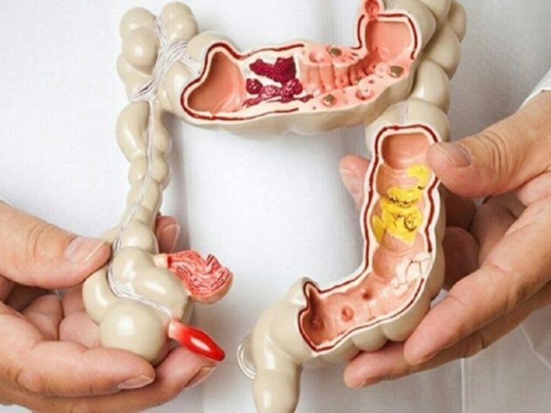 Các phương pháp điều trị ung thư đại tràng ở giai đoạn cuối