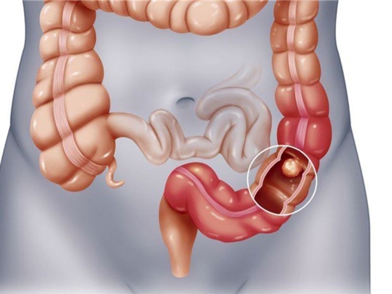 Cách chẩn đoán căn bệnh ung thư đại tràng phổ biến