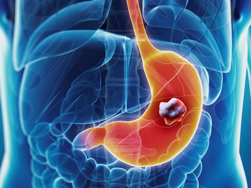 Căn bệnh ung thư dạ dày có xu hướng trẻ hóa