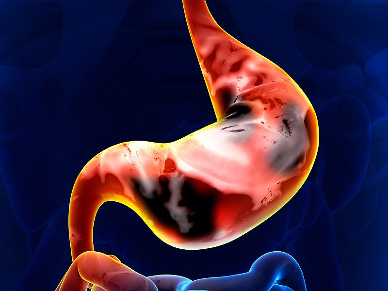 Căn bệnh ung thư dạ dày đang có xu hướng trẻ hóa