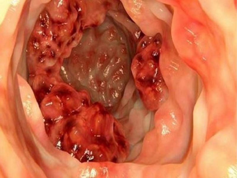 Dấu hiệu của căn bệnh ung thư đại tràng giai đoạn cuối