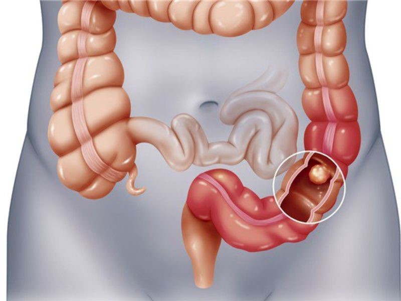 Dấu hiệu của căn bệnh ung thư đại tràng