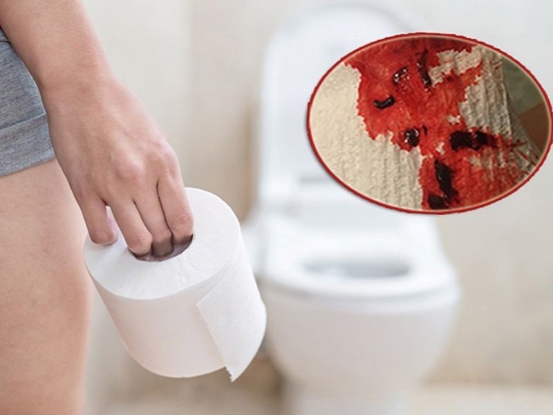 Đi vệ sinh ra nhầy máu, máu ở trong phân