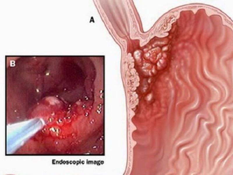 Lưu ý khi sử dụng lá đu đủ chữa ung thư dạ dày
