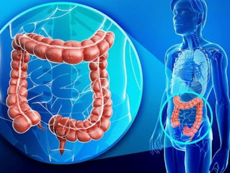 Nguyên nhân của ung thư đại tràng