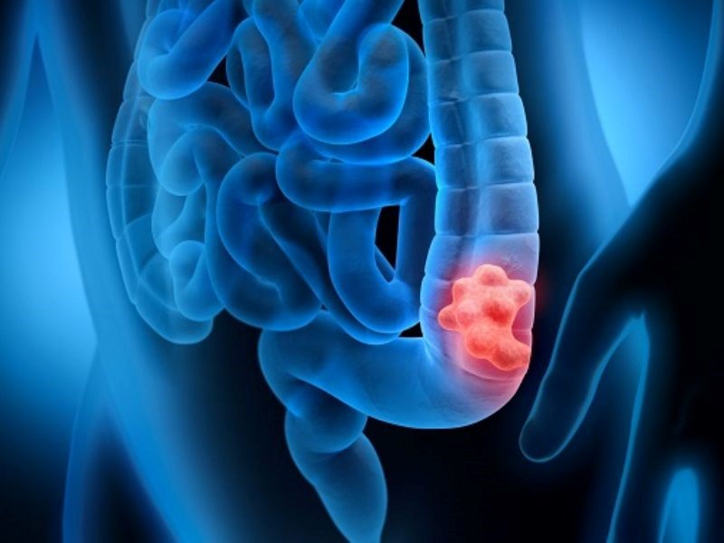 Nguyên nhân của ung thư đại tràng