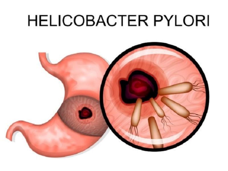 Những hiểu lầm về vi khuẩn HP