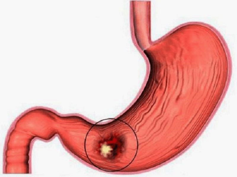 Những người bị viêm dạ dày mãn tính có nguy cơ mắc ung thư dạ dày cao hơn