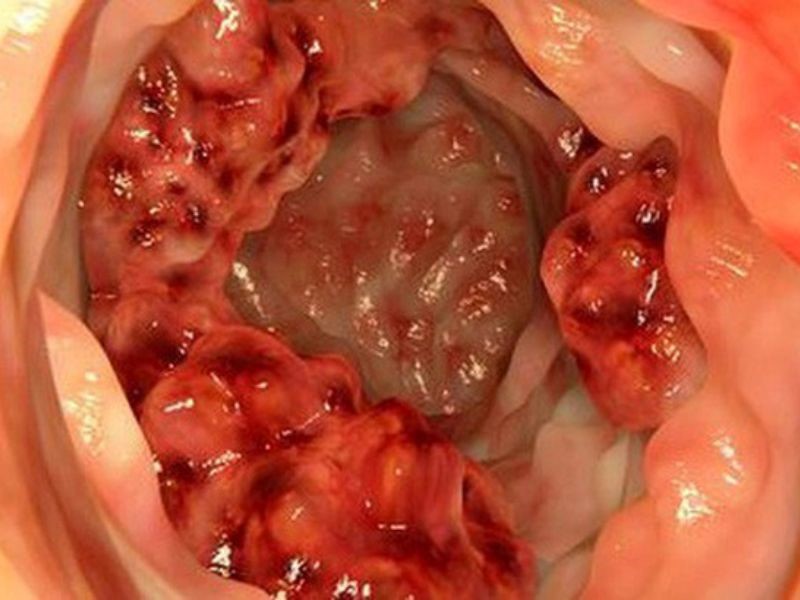 Phương pháp chẩn đoán căn bệnh ung thư đại tràng