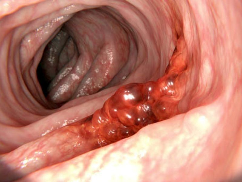 Quan niệm của Đông y về căn bệnh ung thư dạ dày