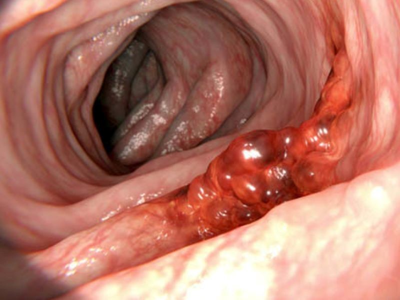 Siêu âm có phát hiện ung thư dạ dày không?