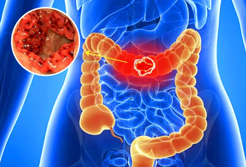 Tiên lượng sống của bệnh nhân ung thư đại tràng giai đoạn 2