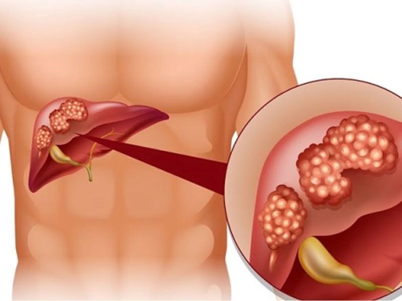 Tiên lượng sống của bệnh nhân ung thư đại tràng giai đoạn cuối