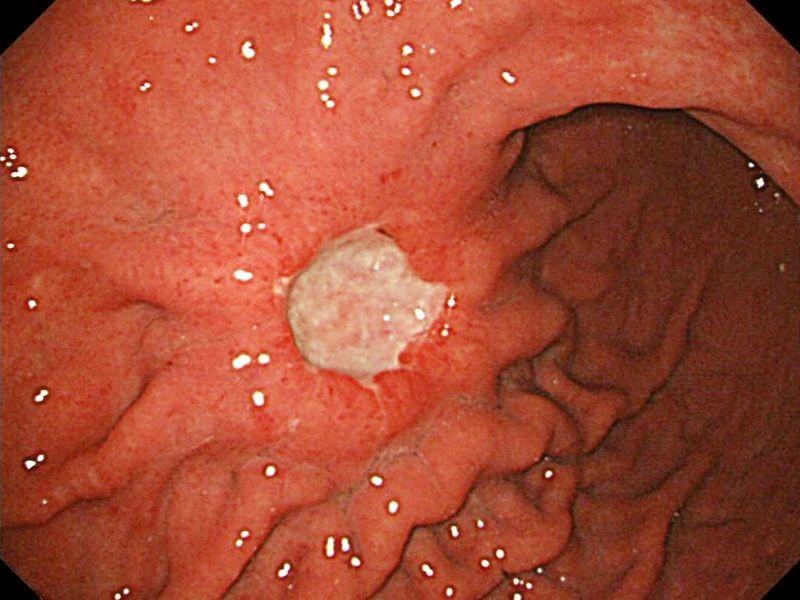 Ung thư dạ dày có chữa được không?