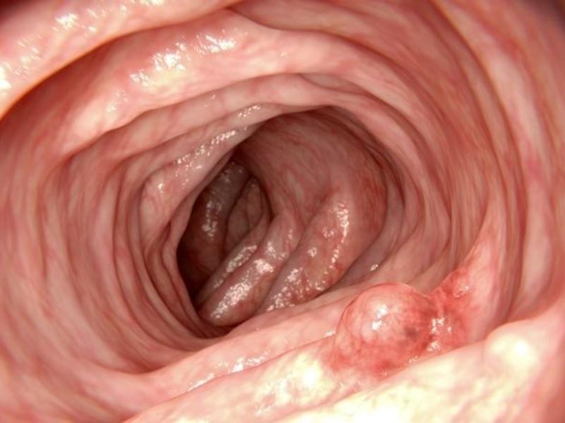 Ung thư đại tràng giai đoạn 1