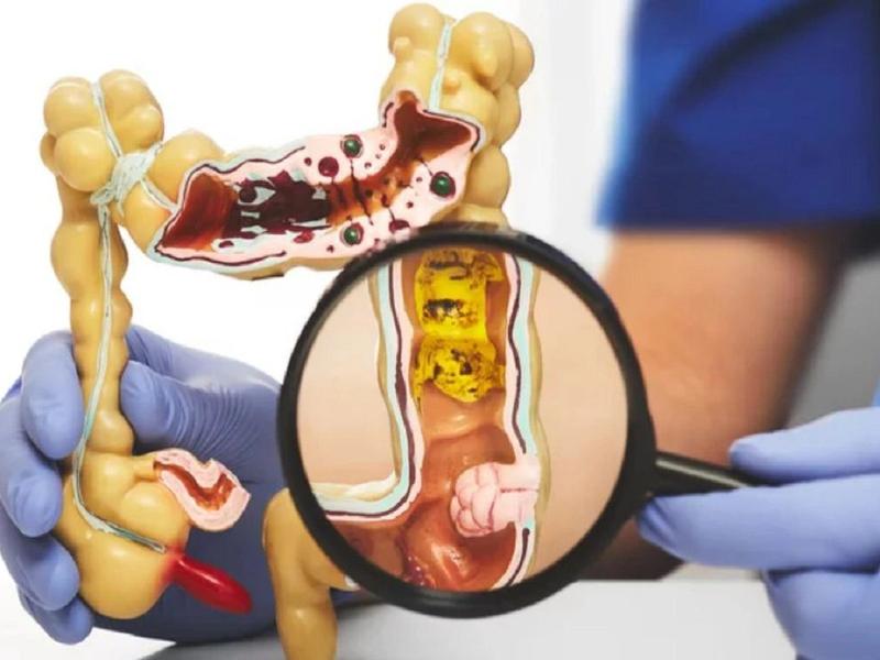 Ung thư đại tràng giai đoạn 2