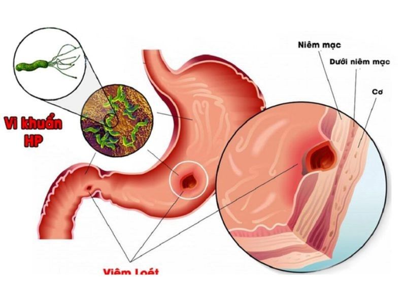 Vi khuẩn HP có thể là nguyên nhân gây ung thư dạ dày