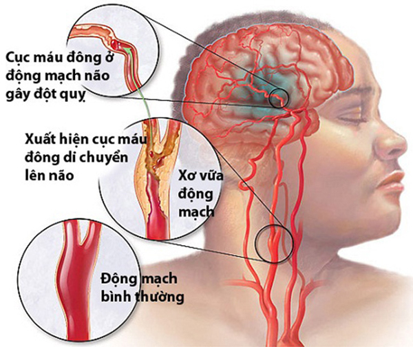  Biến chứng bệnh đái tháo đường lên hệ thần kinh