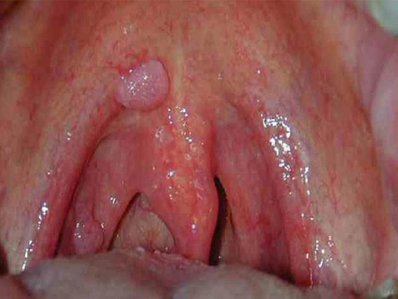 Ung thư vòm họng giai đoạn 3 và những điều bạn cần biết