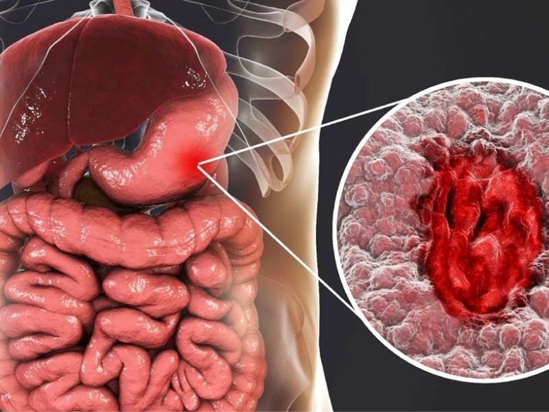 [Giải đáp] Ung thư dạ dày sống được bao lâu? Tiên lượng sống của từng giai đoạn