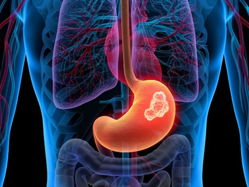 Cách chăm sóc và điều trị ung thư dạ dày giai đoạn đầu