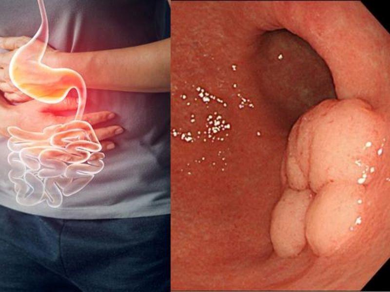 Ung thư dạ dày có chữa được không?