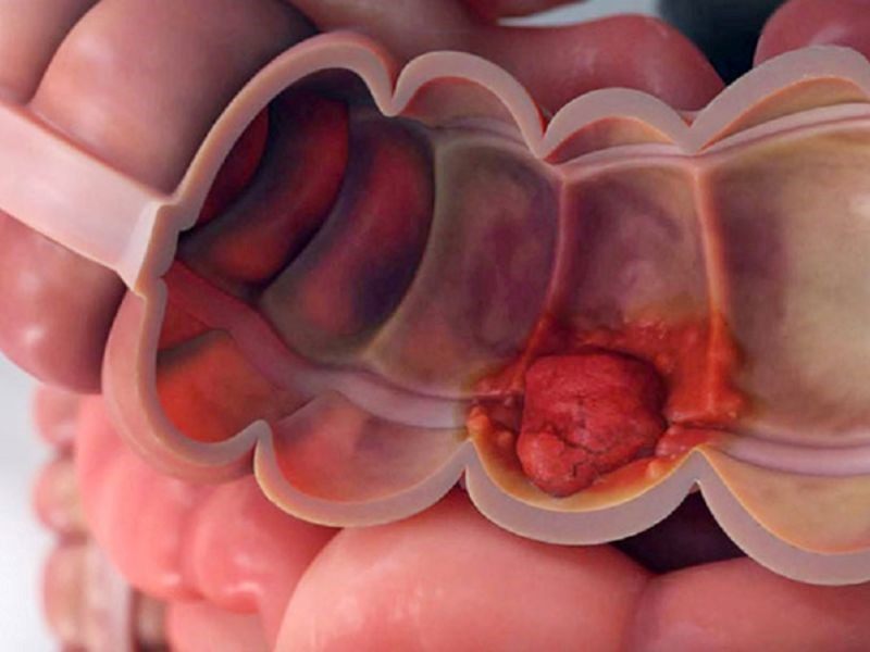 Ung thư đại tràng có chữa được không?
