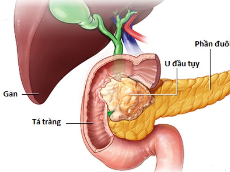 Bệnh nhân ung thư tuyến tụy sống được bao lâu?