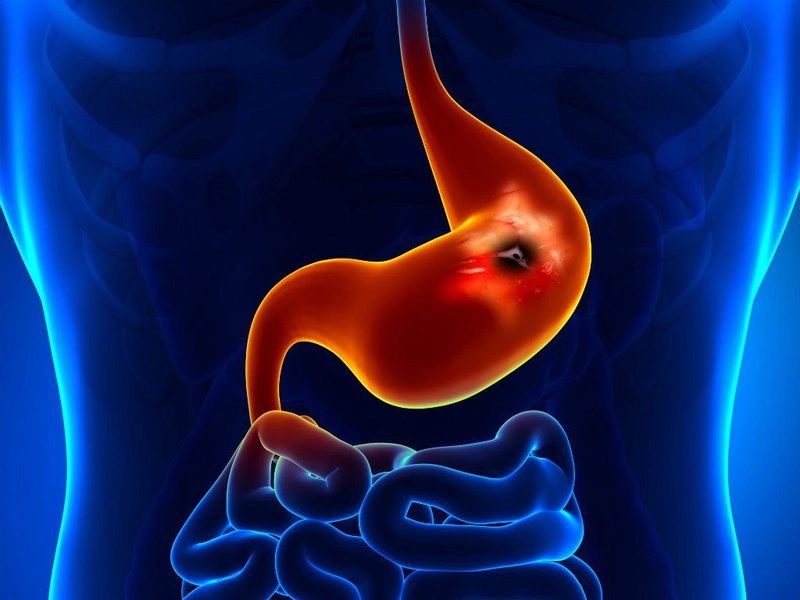 Ung thư dạ dày sống được bao lâu?