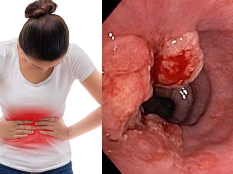 Ung thư dạ dày di căn và những điều bạn cần biết