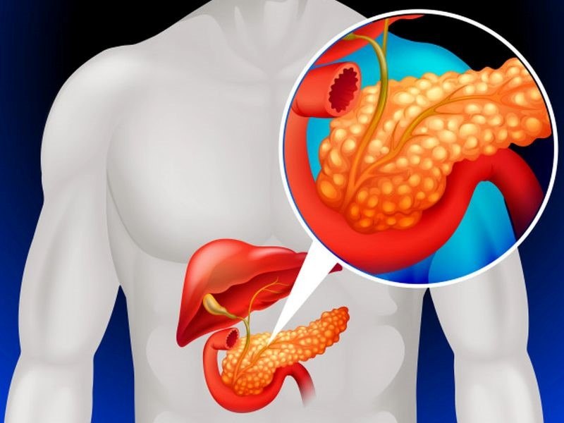 Ung thư tuyến tụy di căn gan và những điều bạn cần biết