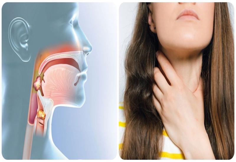 Ung thư vòm họng sống được bao lâu?