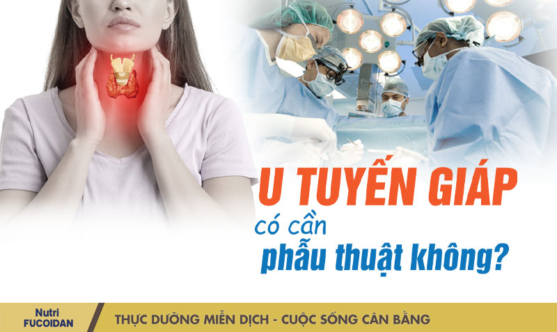 U tuyến giáp có cần mổ không?