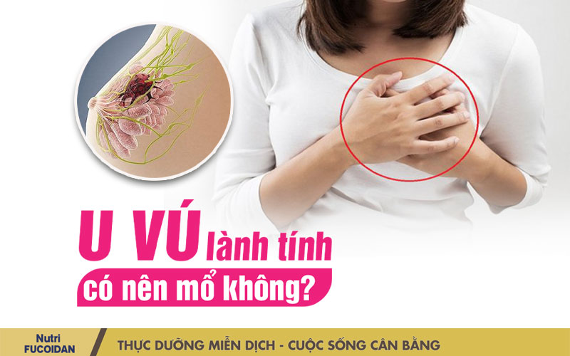 U vú lành tính có nên mổ không