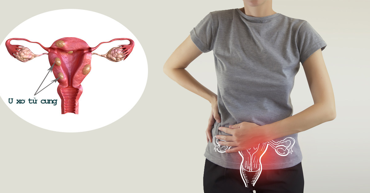 U xơ tử cung là gì? U xơ tử cung có điều trị tại nhà được không?