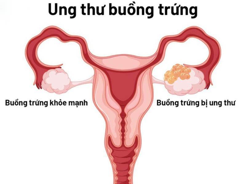 Ung thư buồng trứng: Nguyên nhân, dấu hiệu, cách chẩn đoán và điều trị